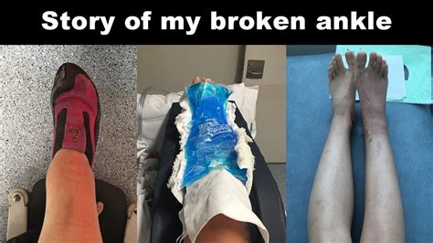 Story Of My Broken Ankle Trimalleolar Ankle Fracture Youtube