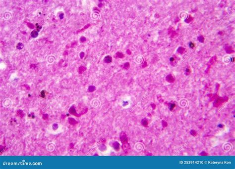 Purulent Meningitis Light Micrograph Stock Photo Image Of