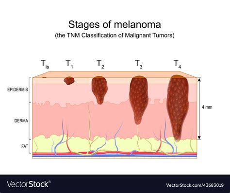 Stages Of Melanoma The Tnm Classification Of Malignant Tumors Vector