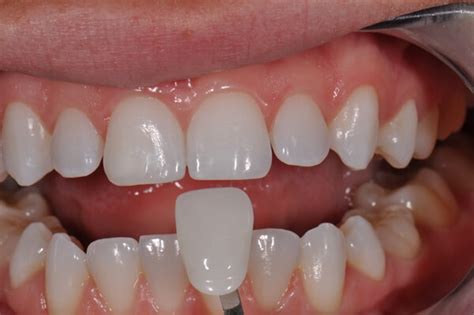 Veneers Before And After Pictures Popularity Time Color Pros