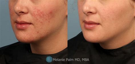 Acne Scarring Before And After Acne Scarring Treatment