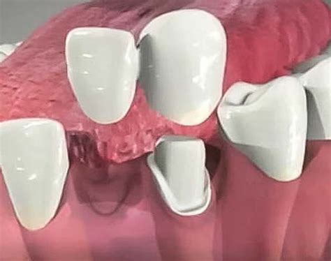 Dental Bridge Treatments At The Cambridge Dental Hub