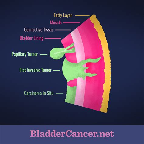 Understanding The Different Types And Forms Of Bladder Cancer