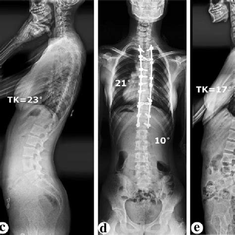 A 16 Year Old Boy With A Main Left Thoracic Curve Secondary To Chiari I