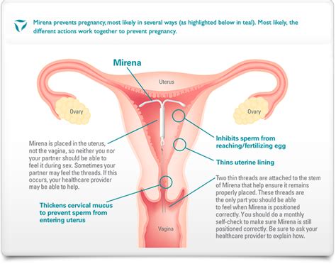 Using A Mirena For Birth Control