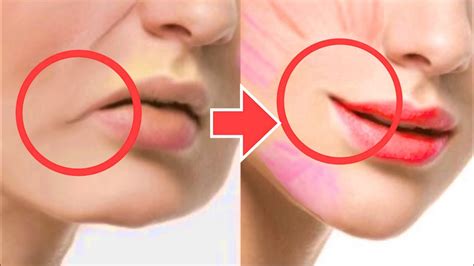lift lip corners fix droopy mouth corners fat around the mouth sagging cheeks asymmetrical