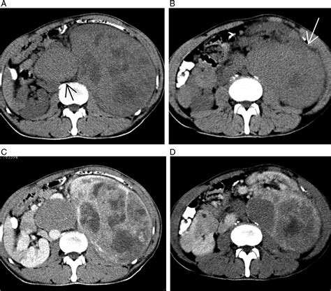 A Massive Renal Epithelioid Angiomyolipoma With Multiple Metastatic
