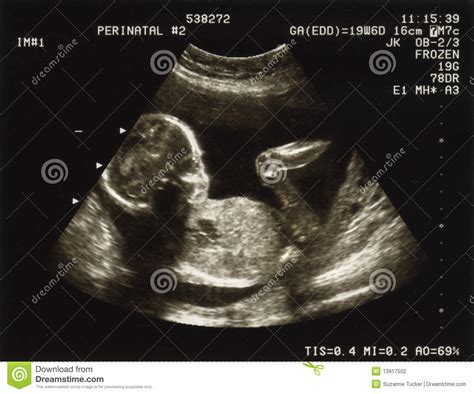 Ultrasound Of A Fetus At 20 Weeks Stock Photography Image 13917502