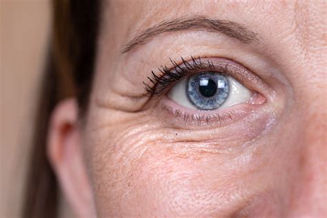 Eye Rejuvenation Treatment The Lifestyle Clinic