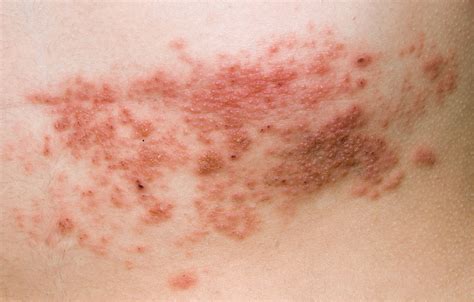Diagnosis And Management Of Common Viral Skin Infections Thandi