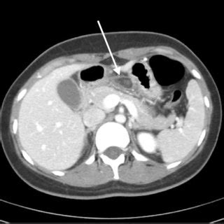 A 2 Month Follow Up Contrast Enhanced Abdominal CT Scan Shows That The