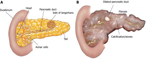 If it is diagnosed at an early stage then an operation to remove the cancer for more information about the pancreas, including pancreas location, see what does the pancreas do? Structure of pancreas. A: The pancreas is a leaf-like ...