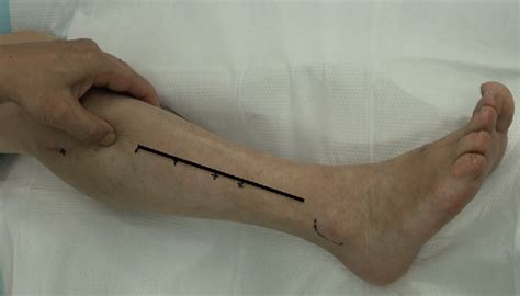 Figure 1 From Clinical Features And Surgical Treatment Of Superficial