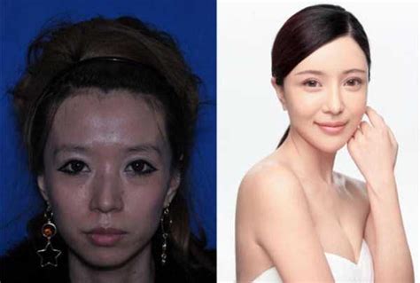 Chinese Women Before And After Plastic Surgery Procedures 19 Photos