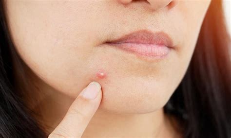Pimples Causes Treatments And Home Remedies Sentinelassam