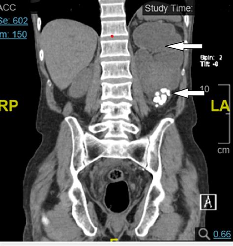 Coronal Ct View Of Abdomen And Pelvis Displaying Severe Left