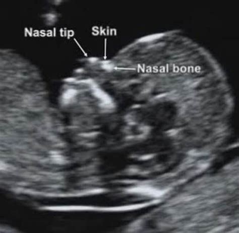 Normal 12 Week Baby Ultrasound Ultrasoundfeminsider