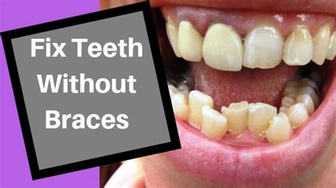 Well, a little more complicated. How To Fix Crooked Teeth Without Braces At Home - Homemade ...