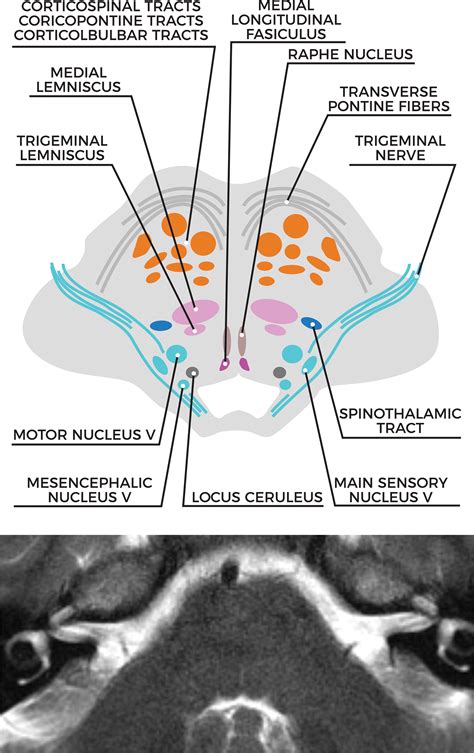 Midbrain Pons And Medulla Anatomy And Syndromes Radiographics