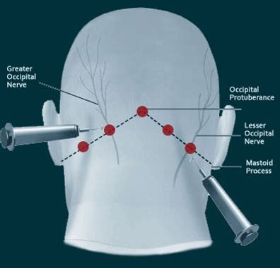 Occipital Nerve Blocks Complete Spine And Pain Care