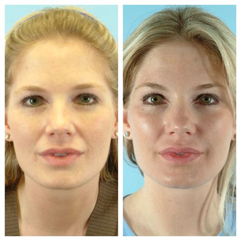 Before And After Of Dermal Fillers Plasticsurgery Lip Pump Facial