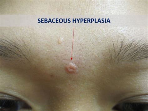 Natural Sebaceous Hyperplasia Treatment At Home Sebaceous Hyperplasia