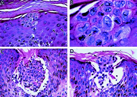 Langerhans Cell Microgranulomas Pseudo‐pautrier Abscesses