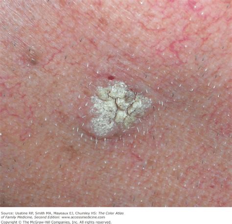 Seborrheic Keratosis Basicmedical Key