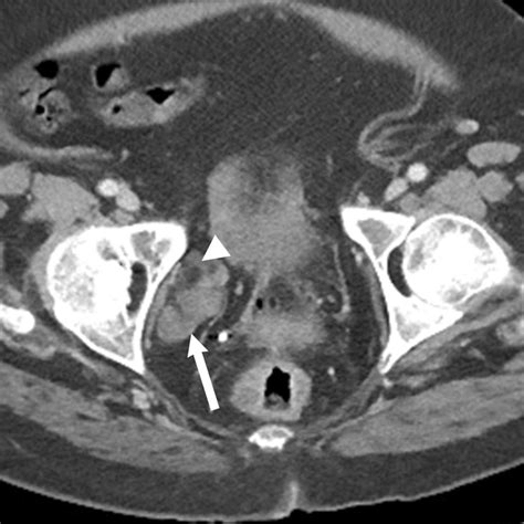 Extra Adrenal Myelolipoma Axial Contrast Enhanced Ct Shows A