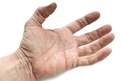 Psoriasis Skin Disease Stock Photo Image Of Isolated 122140822