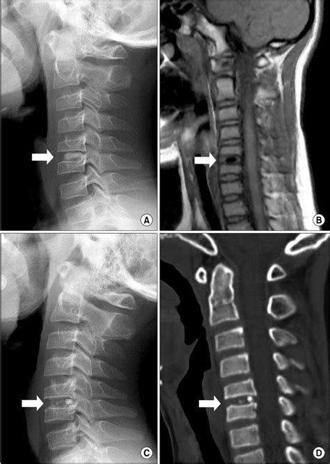 A Lateral Radiograph Of The Cervical Spine Showing Dense