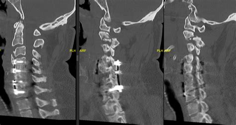 Sagittal Ct C Spine Demonstrating Unstable Atypical Hangmans Fracture