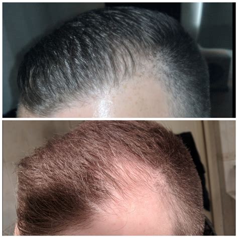 1981 best r/tressless images on Pholder | Topical minox nightly, 9 months