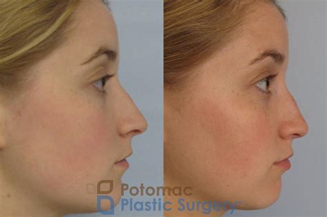 Rhinoplasty And Septoplasty To Lift A Droopy Nose And Improve Breathing