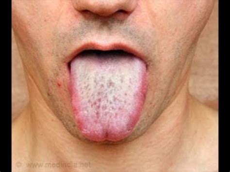 Oral Candidiasis Oral Thrush Causes Symptoms How To Treat White Tongue Youtube