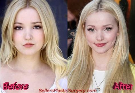 Dove Cameron Face Before And After Plastic Surgery