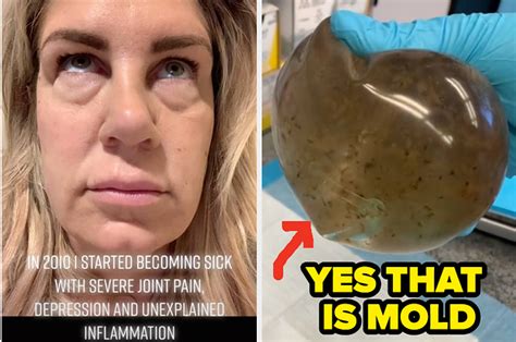 Yes Thats Mold — For Years This Woman Suffered Unimaginable