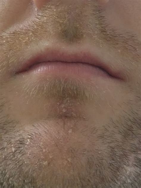 Skin Concerns Dry Flaky Skin In Beard Hair What Causing It What