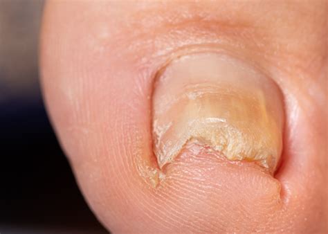 What To Do For Ingrown Toenails Next Step Foot And Ankle Clinic