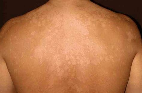 Tinea Versicolor Pictures Contagious Symptoms Treatment