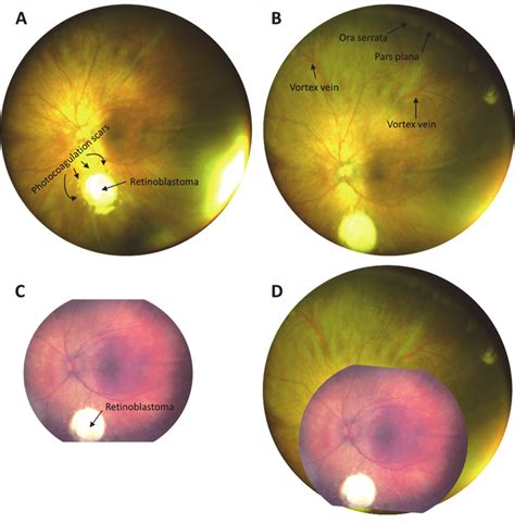 Fundus Images Of A Patient Previously Diagnosed With Retinoblastoma