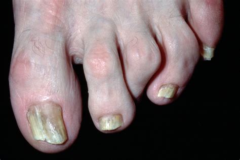 Can You Identify These Toe Problems Pulse Today
