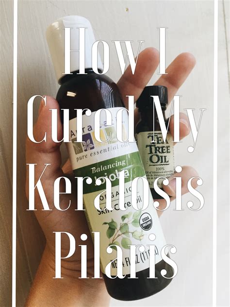 My Simple Cure To Keratosis Pilaris The February Collection
