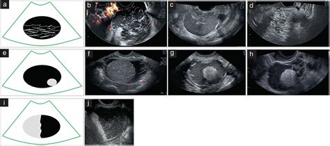 Imaging In Gynecological Disease Clinical And Ultrasound