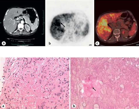 Figure 2 From Liver Tuberculosis Presenting As An Uncommon Cause Of