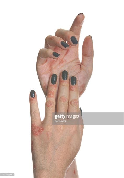 Psoriasis Hand High Res Stock Photo Getty Images