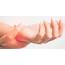 Where To Find Expert Wrist Sprain Treatment In Glen Mills  Rothman