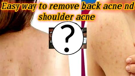 Easy Way To Remove Back Acne Nd Shoulder Acne Youtube