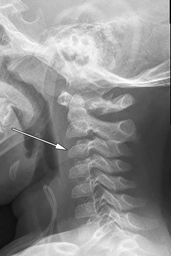 Emergent Imaging Of Pediatric Cervical Spine Trauma Radiographics