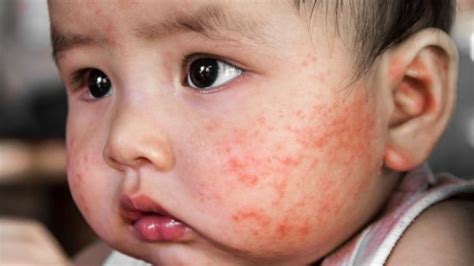 Sintomas E Tratamento Da Dermatite Atópica Na Infância Blog Pulmolab